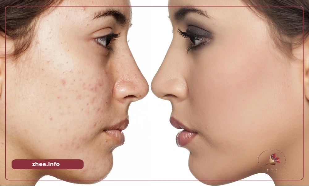 درمان جوش زیرپوستی